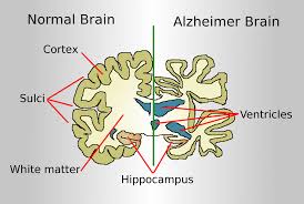 Alzheimer İçin Erken Teşhis Testleri 